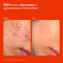 Tower 28 Beauty - Skincare - SOS Daily Hypochlorous Acid Spray for Breakouts & Redness
